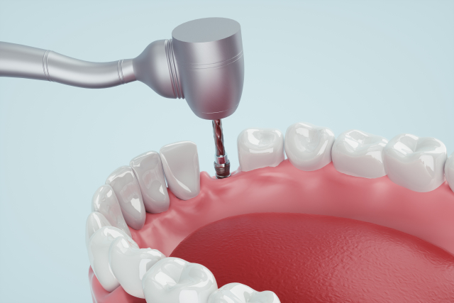 インプラント埋入手術