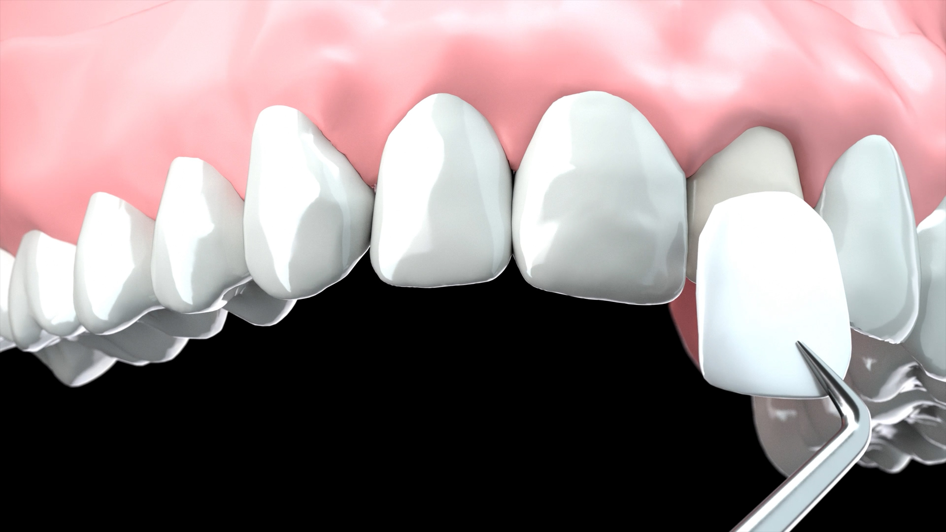 ラミネートベニア